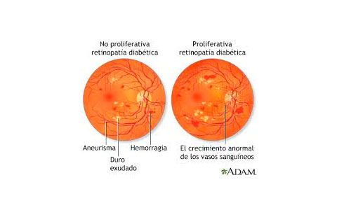 Retinopatía