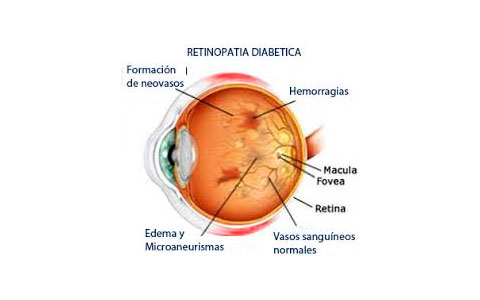 Retinopatía